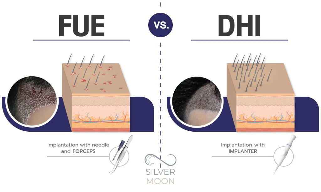 مقایسه روش DHI و FUE در کاشت ابرو