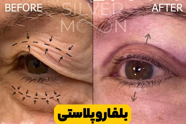 قبل و بعد بلفارو