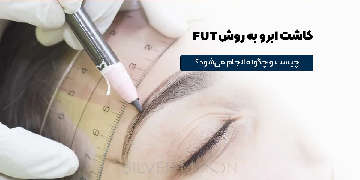 کاشت ابرو به روش FUT