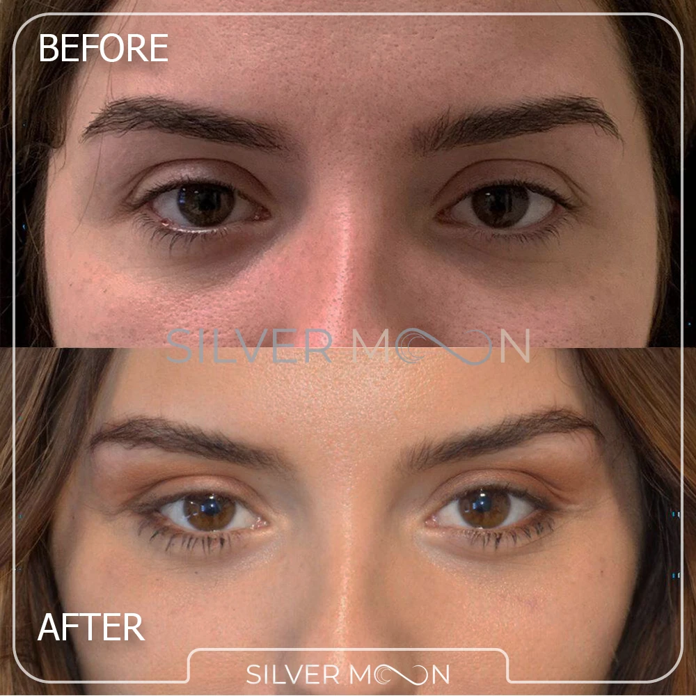 تصاویر عمل چشم گربه ای