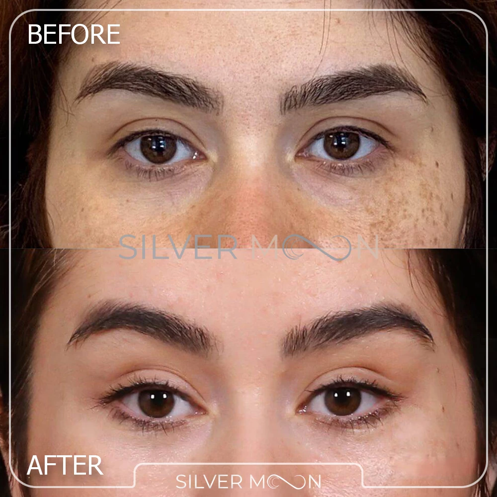 نمونه کار جراحی چشم گربه ای کانتوپلاستی