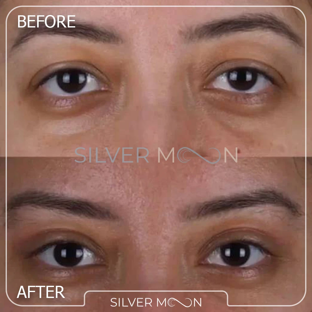 نمونه کار جراحی چشم گربه ای کانتوپلاستی