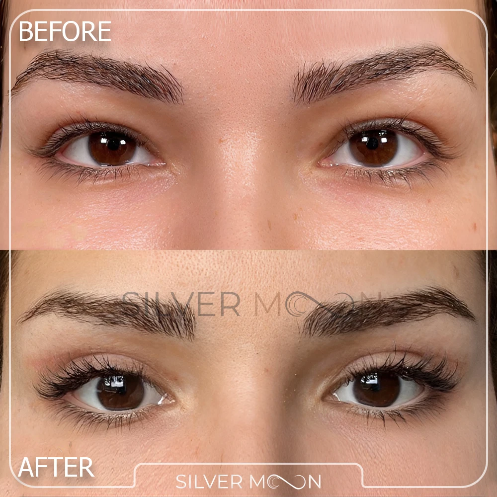 نمونه کار بهترین دکتر بلفاروپلاستی در تهران