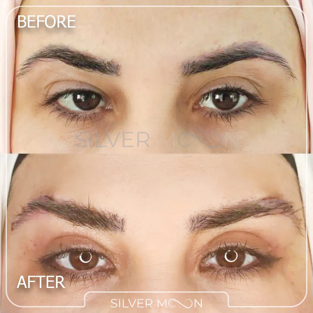 نمونه کار لیفت دایرکت ابرو