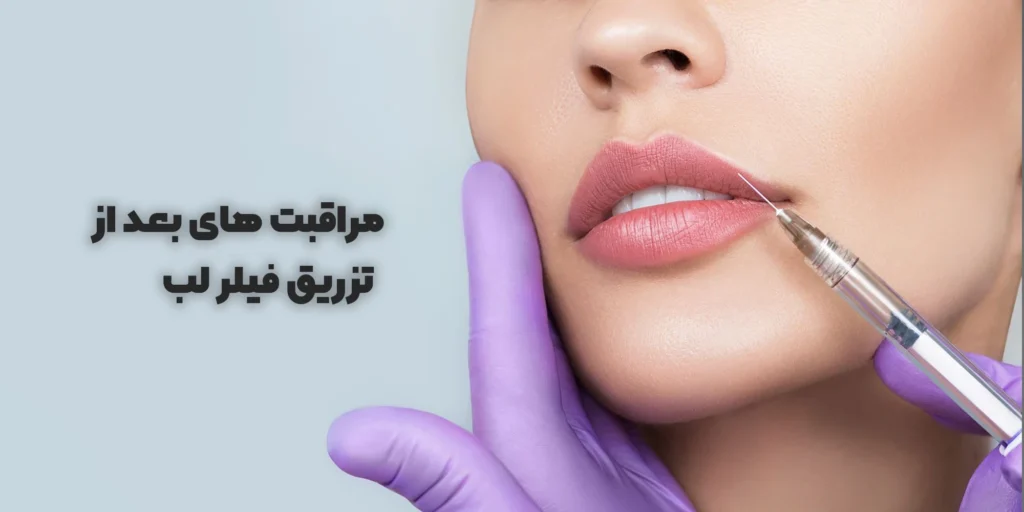 مراقبت‌های بعد از تزریق فیلر لب