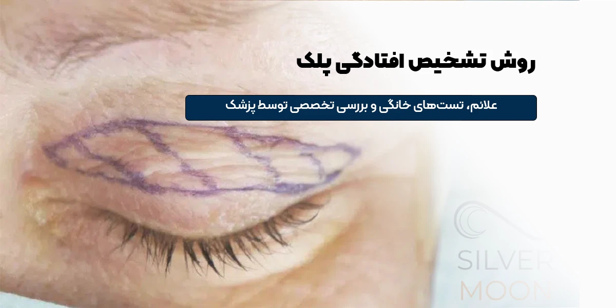 روش تشخیص افتادگی پلک