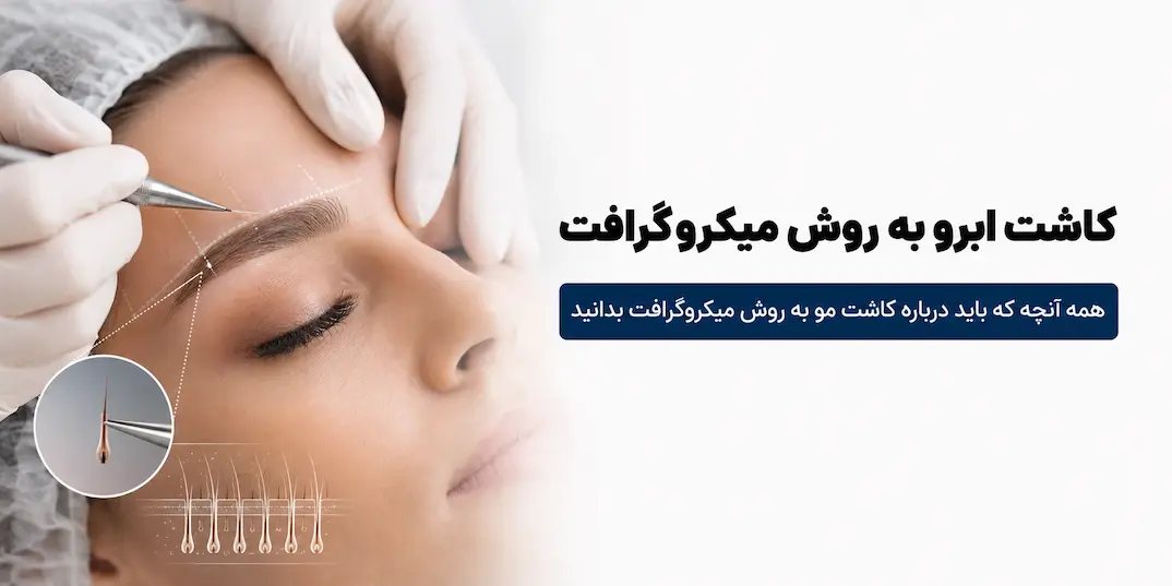 کاشت مو به روش میکروگرافت